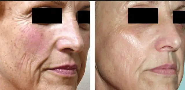 Laser frakcyjny co to jest i jakie przynosi korzyści dla skóry