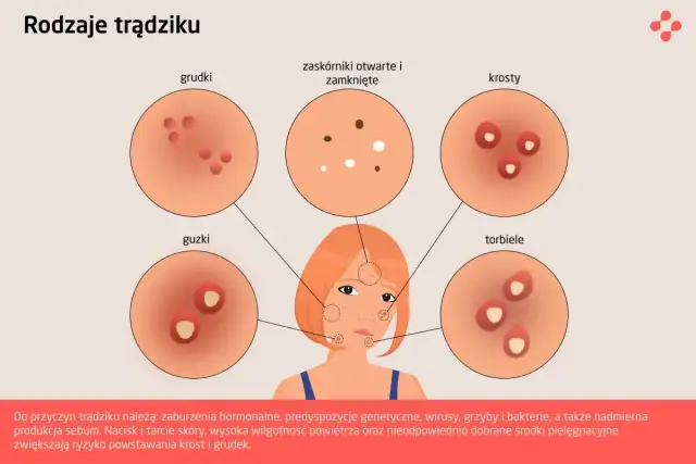 Jak wygląda trądzik - Poznaj rodzaje zmian i naucz się je rozpoznawać