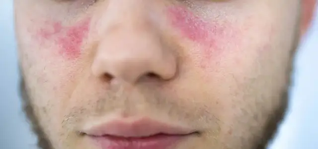 Jakie leki na toczeń? Skuteczne terapie i ich działanie