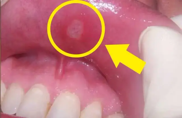 Zmiany w jamie ustnej: do jakiego lekarza się udać i kiedy to pilne?