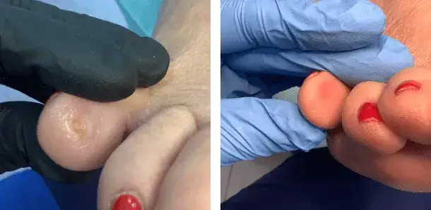 Chirurg usunie odcisk? Kiedy to konieczne i co musisz wiedzieć?