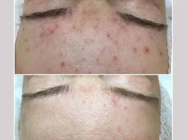 Blizny potrądzikowe: Kompleksowy przewodnik usuwania. Co działa?