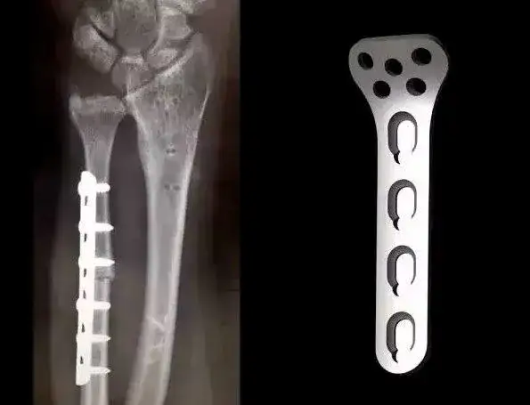 Płytką tytanową czy można z tym życiu? Poznaj prawdę o codzienności