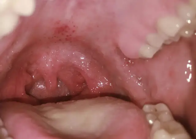 Widok jamy ustnej z widocznymi zaczerwienionymi migdałkami, które mogą sugerować bostonkę w gardle.