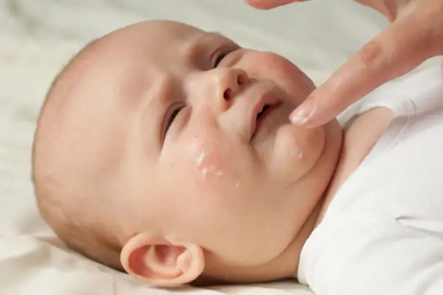 Skaza białkowa czy potówki u niemowlaka? Rozpoznaj bezbłędnie!