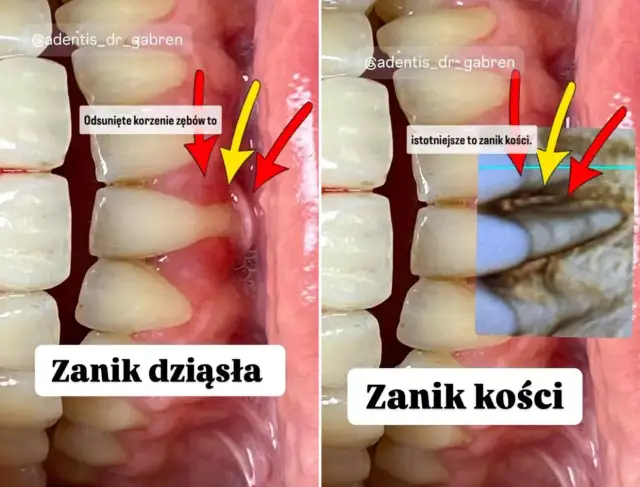 Czy dziąsła odrastają? Prawda o recesji i odbudowie dziąseł