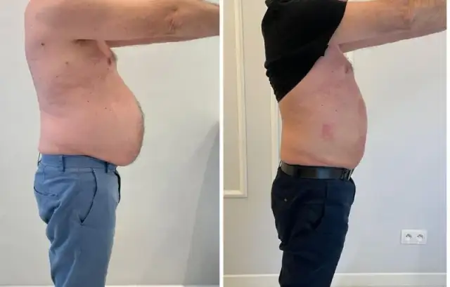 Liposukcja: Modelowanie sylwetki metody, efekty, ryzyko, ceny