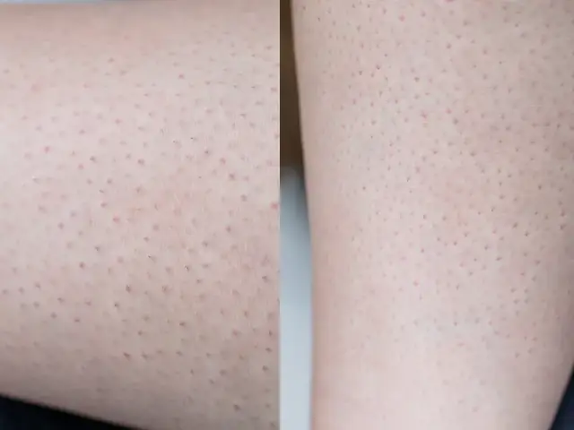 Skóra po depilacji laserowej: Jak wygląda i jak o nią dbać?