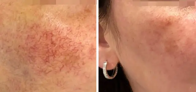 Jak długo goi się skóra po laserze frakcyjnym? Czas regeneracji