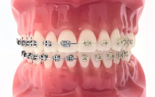 Czy aparat na zęby boli? Jak uniknąć bólu i dyskomfortu podczas noszenia