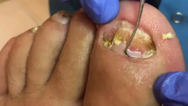 Jak obcinać paznokcie u nóg na YouTube, aby uniknąć błędów