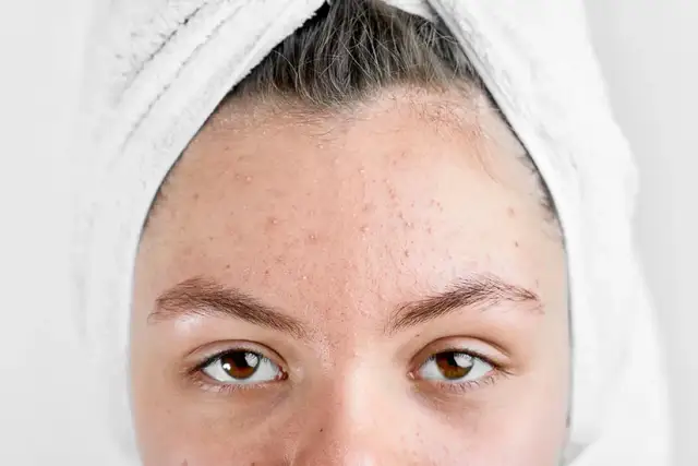 Jak długo trzymać maść ichtiolową na pryszczu, aby uzyskać efekty?