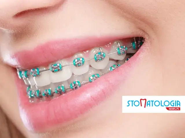 Ile zakłada się aparat na zęby i jak długo trwa całe leczenie?