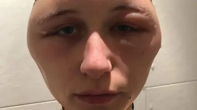 Uczulenie na ogórki kiszone objawy – jak je rozpoznać i unikać