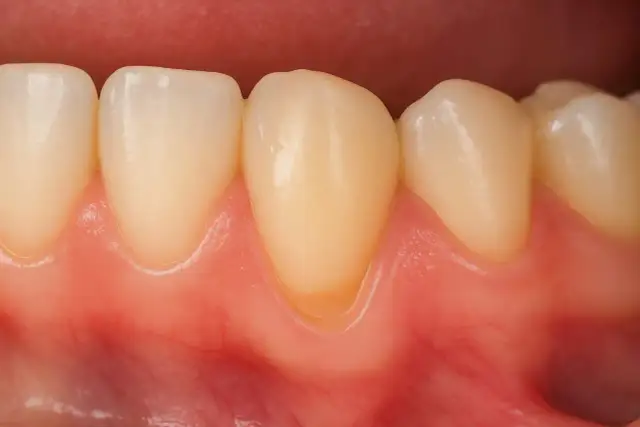 Cofające się dziąsła: jak rozpoznać i skutecznie leczyć? Poradnik