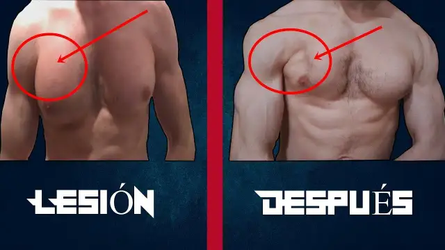 Desgarro muscular en el pecho: síntomas, causas y tratamientos efectivos