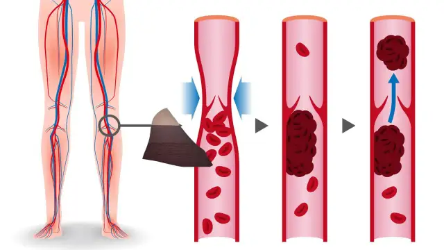 Zaburzenia krzepnięcia krwi objawy - jak je rozpoznać i leczyć