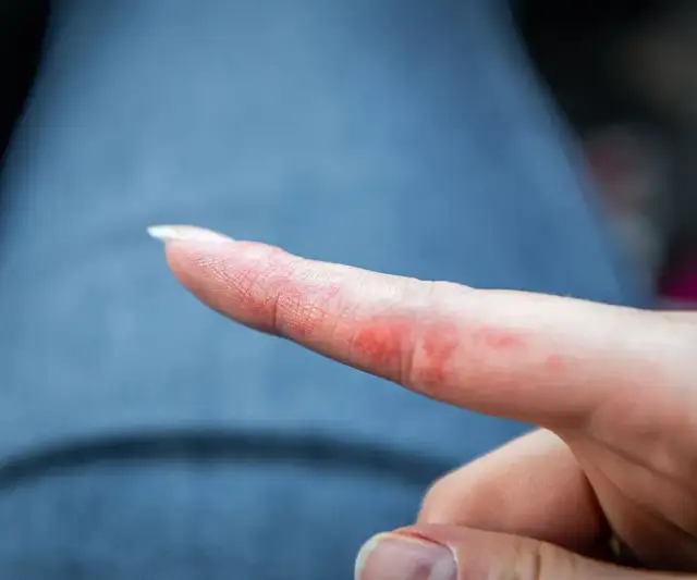 Alergia na nikiel w jedzeniu: objawy, diagnoza i dieta