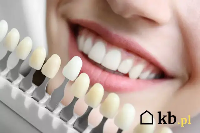 Wybielanie zębów w Polsce: Ceny, metody i sekrety trwałego uśmiechu