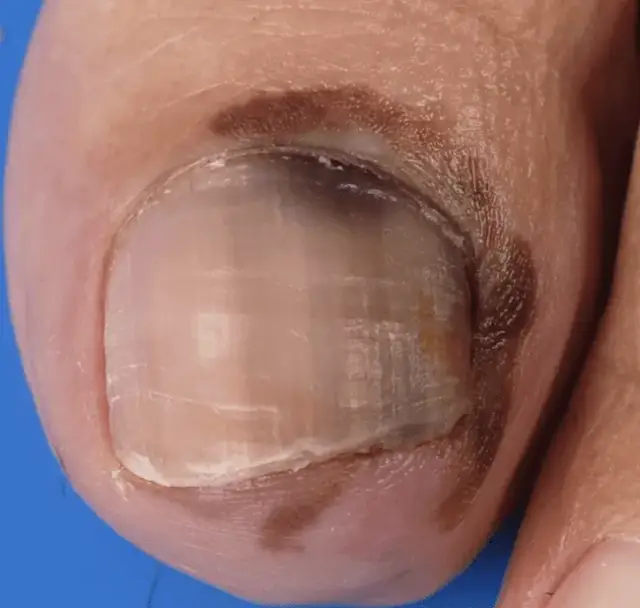 Czy czerniak paznokcia boli? Objawy, które mogą Cię zaniepokoić