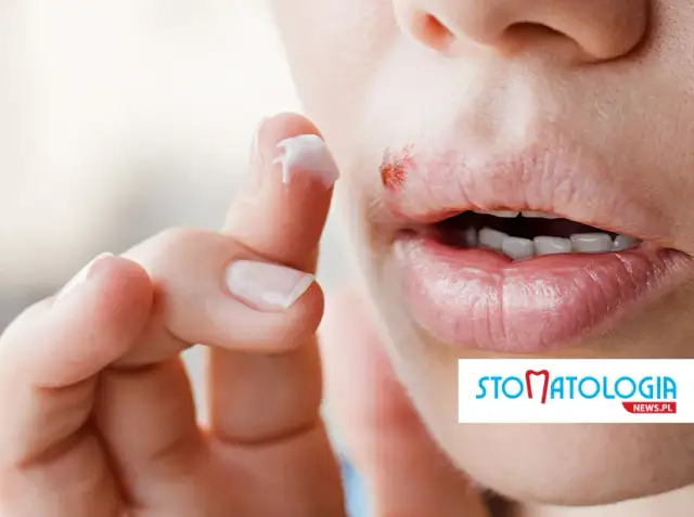 Masz opryszczkę przed dentystą? Sprawdź, kiedy możesz iść!