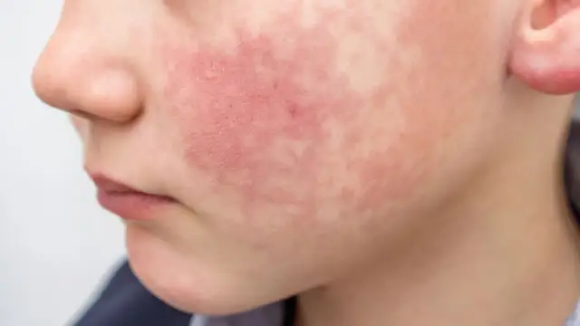 Rumień zakaźny w przedszkolu: Kiedy powrót? Jasne zasady