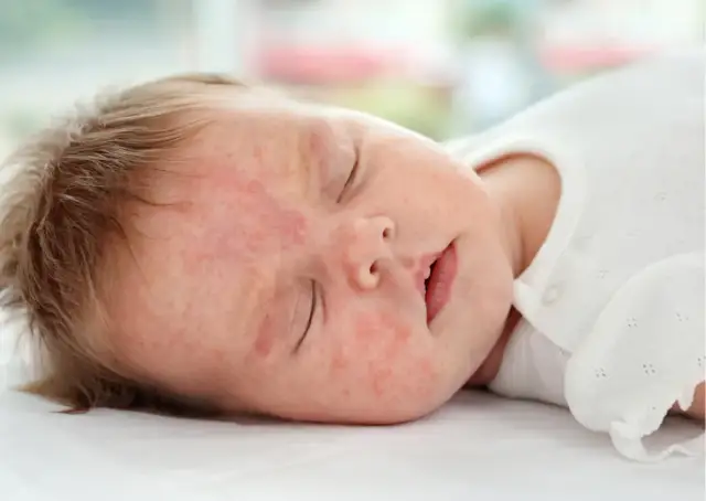 Alergia na mleko modyfikowane objawy – jak je rozpoznać i unikać?