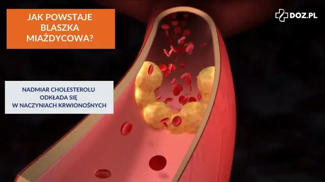 Cholesterol całkowity 220: Granica, sygnał, czy zagrożenie?