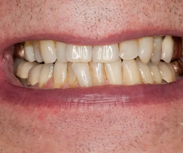 Czy żelazo niszczy zęby? Sprawdź, jak uniknąć przebarwień