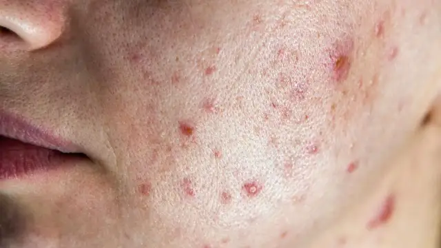 Jak wyglądają pryszcze? Poznaj różnice między rodzajami zmian skórnych