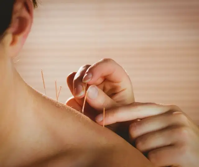 Igły akupunktura: jak działają i jakie przynoszą korzyści?