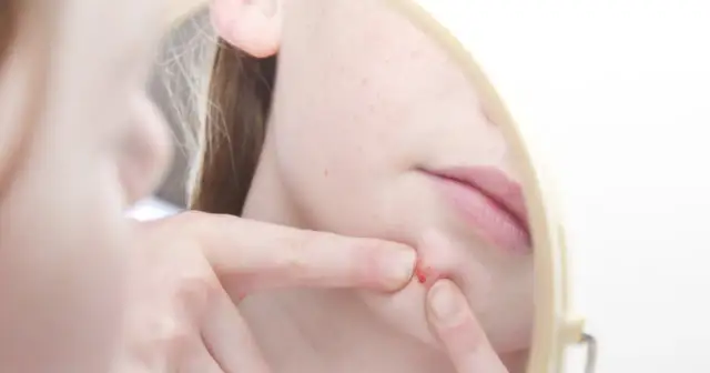 Pryszcze u nastolatków: Co działa? Kompletny przewodnik po trądziku