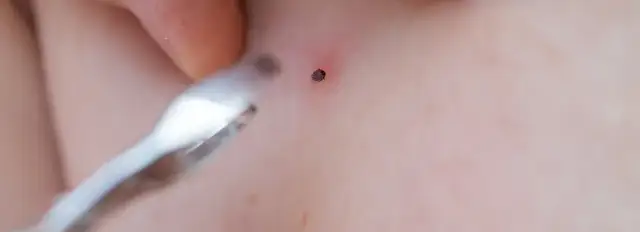 Czym smarować ugryzienie kleszcza? Unikaj tych niebezpiecznych substancji