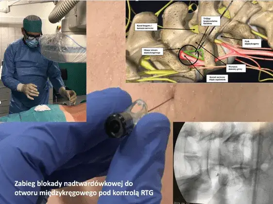 Operacja kręgosłupa lędźwiowego: Jak wrócić do pełni sił? Przewodnik