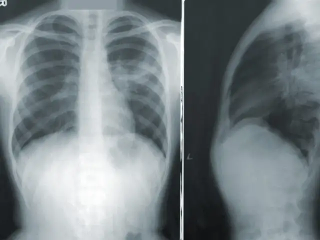RTG klatki piersiowej pokazuje zmiany sugerujące zapalenie płuc. Czy zapalenie płuc jest zaraźliwe? Tak, wiele rodzajów zapalenia płuc jest zaraźliwych.