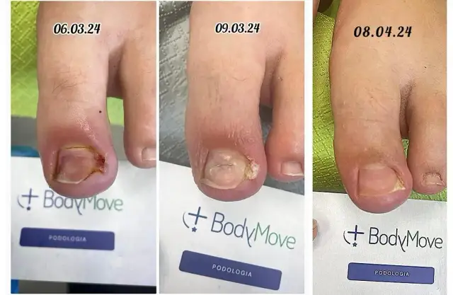 Wrastający paznokieć: Podolog vs Chirurg Kto wyleczy Cię skuteczniej?