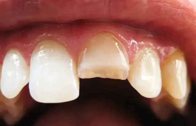 Pęknięty ząb: Uratować czy usunąć? Klucz do decyzji