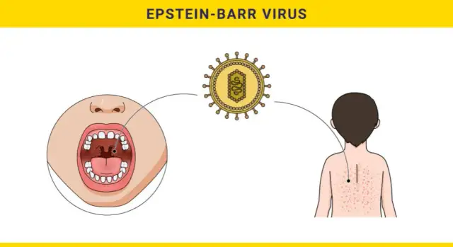 Wirus Epsteina-Barr - objawy i metody leczenia zakażenia