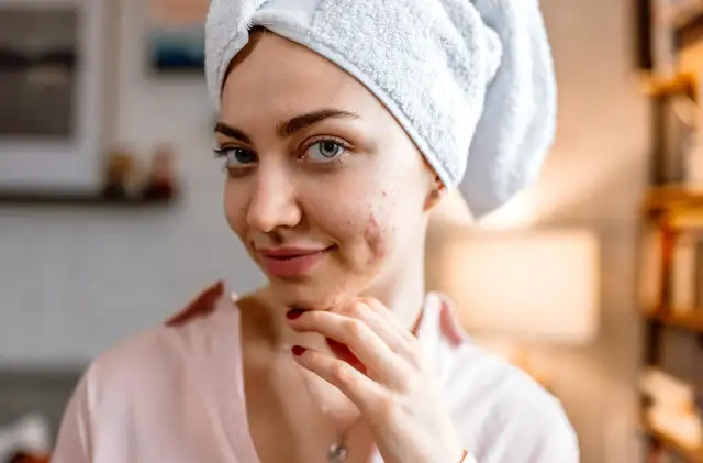 Jak pozbyć się pryszczy? Skuteczne metody i błędy w pielęgnacji