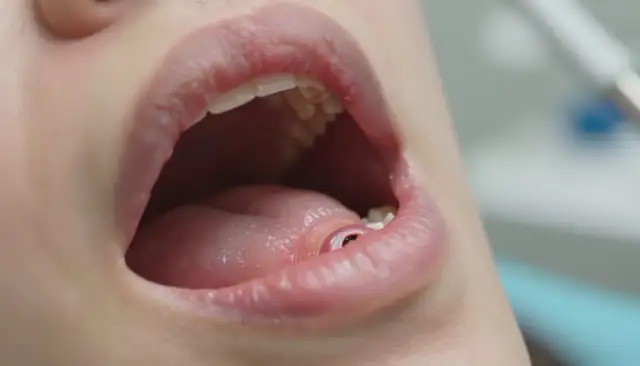 Ile boli dziąsło po wyrwaniu zęba? Norma i sygnały alarmowe