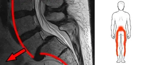 Ból kręgosłupa lędźwiowego: jaki lekarz pomoże w Twoim przypadku?