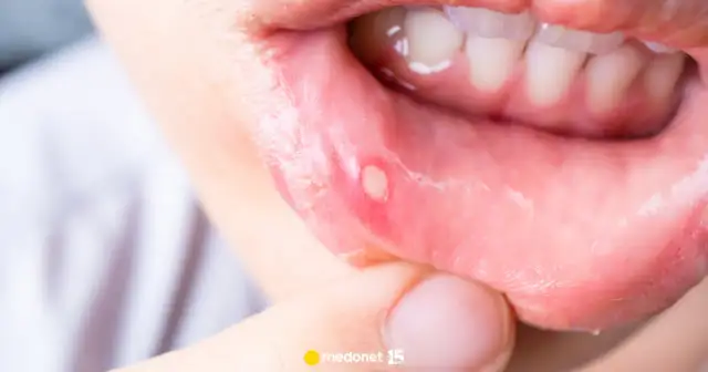 Pędzlowanie jamy ustnej: Krok po kroku na pleśniawki i afty