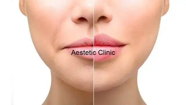 Powiększanie ust: Czy boli? Metody znieczulenia i komfort zabiegu