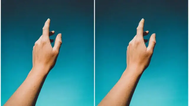 Syndrom obcej ręki: Co to jest? Objawy, przyczyny, leczenie