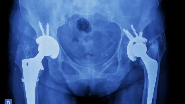 Endoproteza stawu biodrowego NFZ: gdzie najszybciej uniknąć długiego czekania