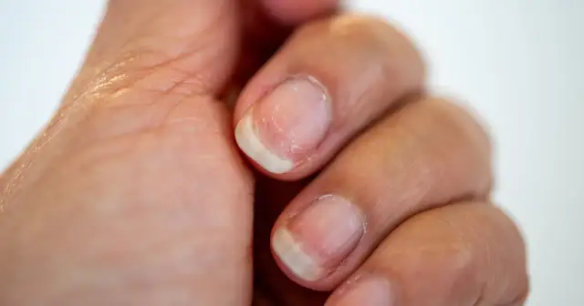 Paznokcie z widocznymi pęknięciami i łuszczeniem. Czy to znak, że żelazo norma jest poza zasięgiem?