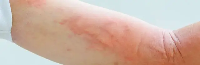 Pokrzywka alergiczna: zobacz zdjęcia, poznaj objawy i leczenie