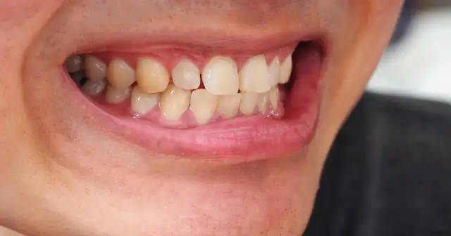 Jak skutecznie pozbyć się żółtych zębów – domowe i profesjonalne metody