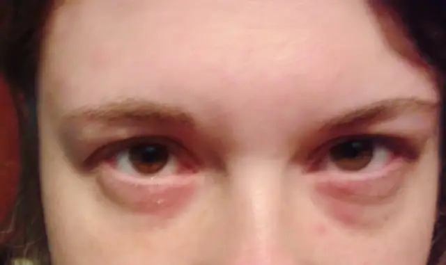 Metal w ustach? Alergia na nikiel: objawy, diagnoza, leczenie