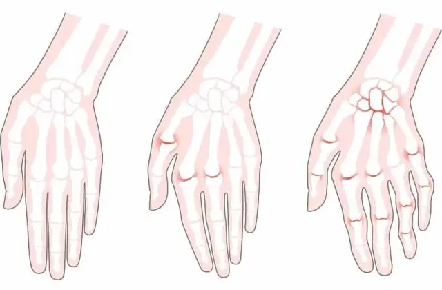 Wczesne objawy reumatoidalnego zapalenia stawów - rozpoznaj RZS